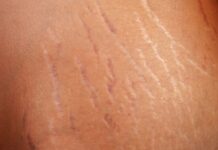 Creams For Stretch Marks Removal, Preventions And What You Need To Know Creams For Stretch Marks Removal