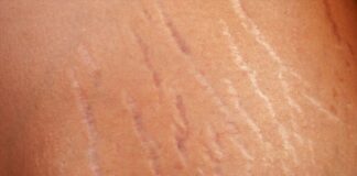 Creams For Stretch Marks Removal, Preventions And What You Need To Know Creams For Stretch Marks Removal