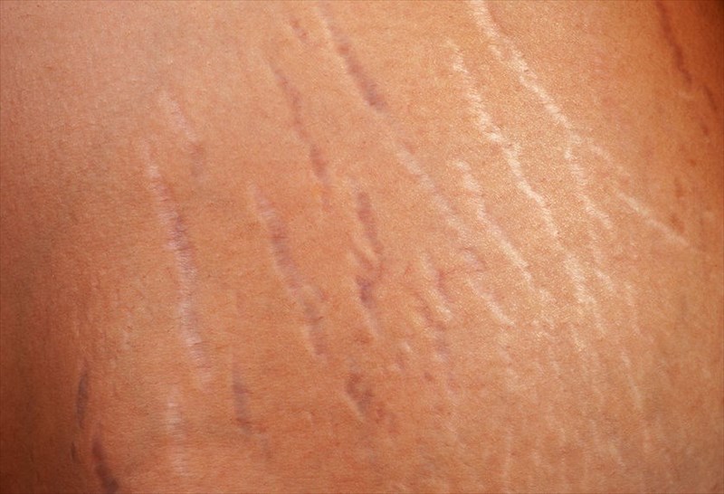 Creams For Stretch Marks Removal